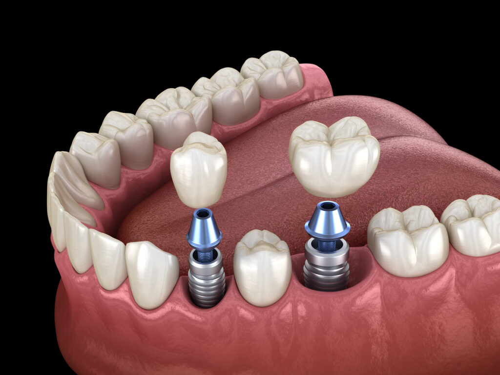 Unlocking the Secret to Pain-Free Dental Implants